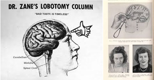 神經(jīng)科學(xué)的黑歷史：前腦葉白質(zhì)切除術(shù)